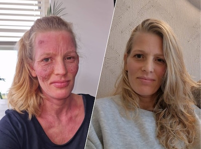 Denise kampte jarenlang met ernstige eczeem, maar een nieuwe uitvinding biedt verlichting